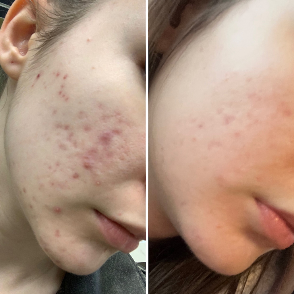 EXOSOME Microneedling