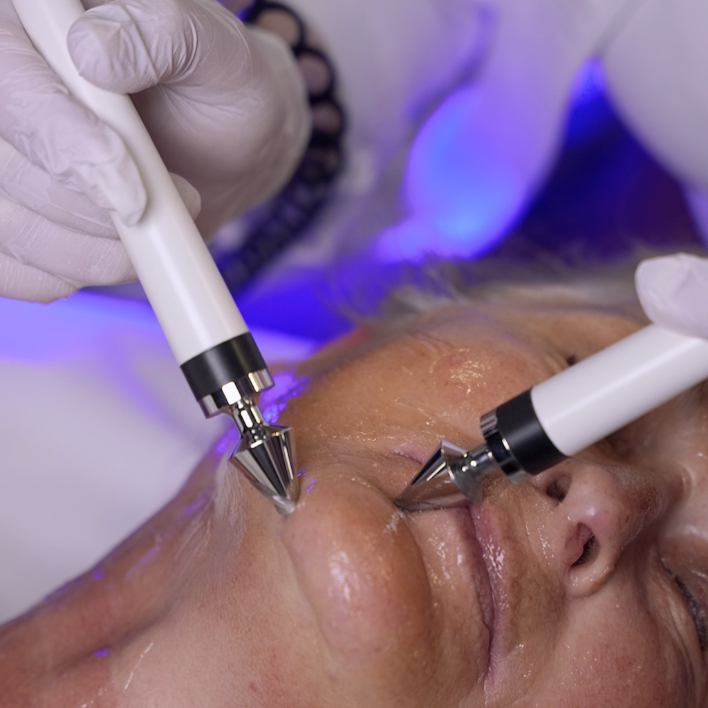 MIKROSTRUJNI LIFTING